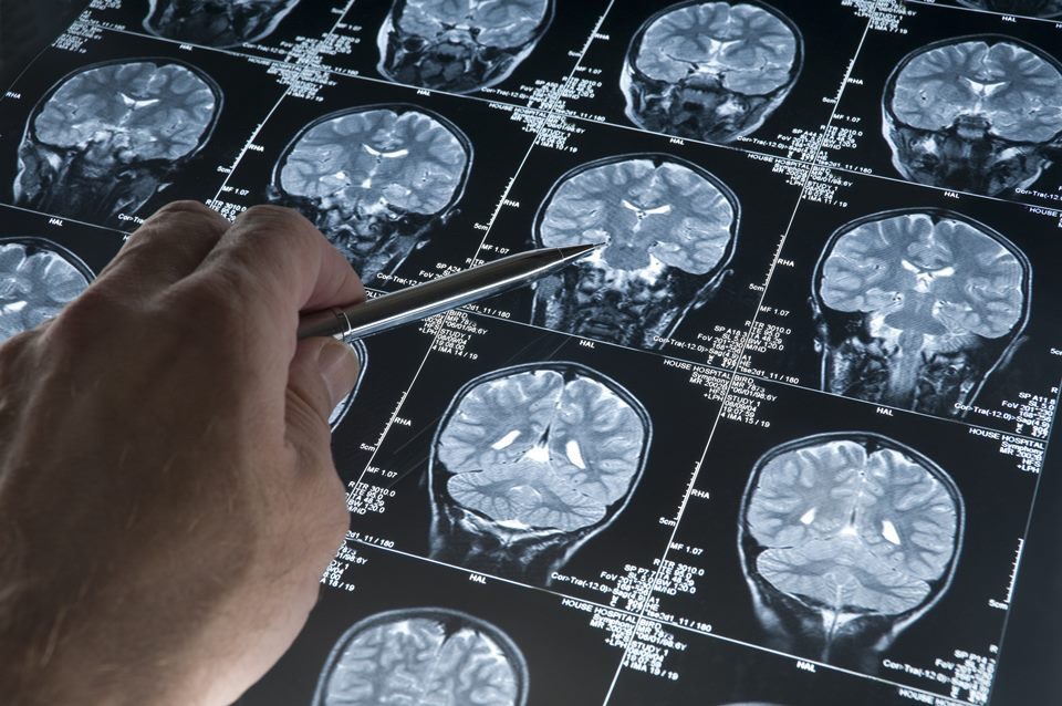 INOVAÇÃO | Aparato para cabeça pode reverter perda de memória do Alzheimer
