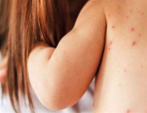 SARAMPO | Brasil atinge 99,4% de cobertura vacinal em 2019