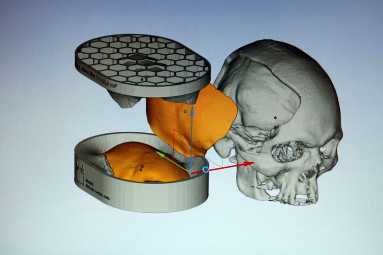 INOVAÇÃO | Brasileiros desenvolvem tecnologia de reconstrução craniana e técnica poderá ser utilizada nos hospitais