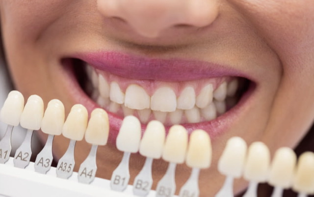 TENDÊNCIA ENTRE CELEBRIDADES | Problemas bucais resolvidos com as lentes de contato dental