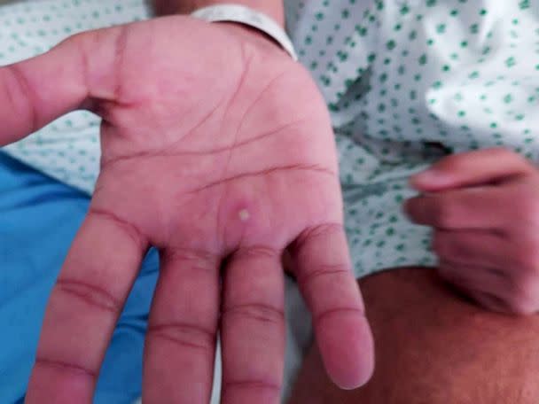 MONKEYPOX NO DF | Secretaria de Saúde confirma que 93 pessoas estão com a doença