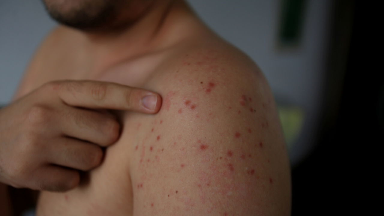 SARAMPO NO DF | Capital federal registra primeiro caso da doença desde 2020